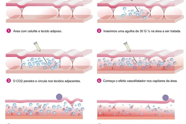 Carboxiterapia