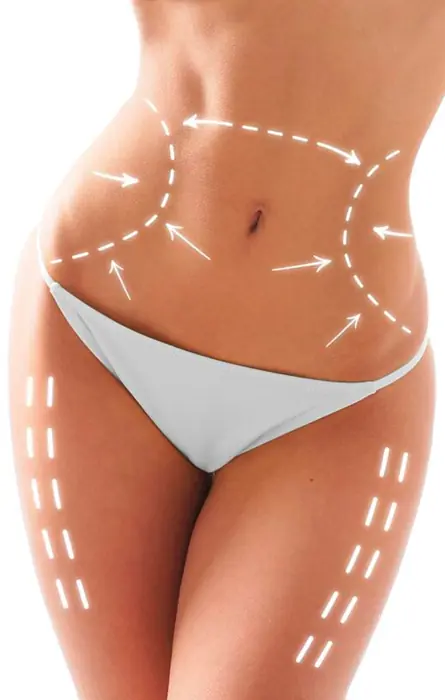 Lipocavitação